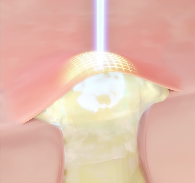 A+雷射 image